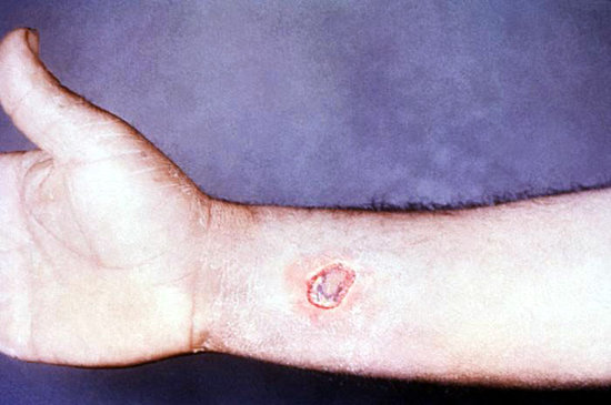 wolf-spider-bite.jpg