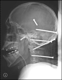 _40117643_nailxray203.jpg
